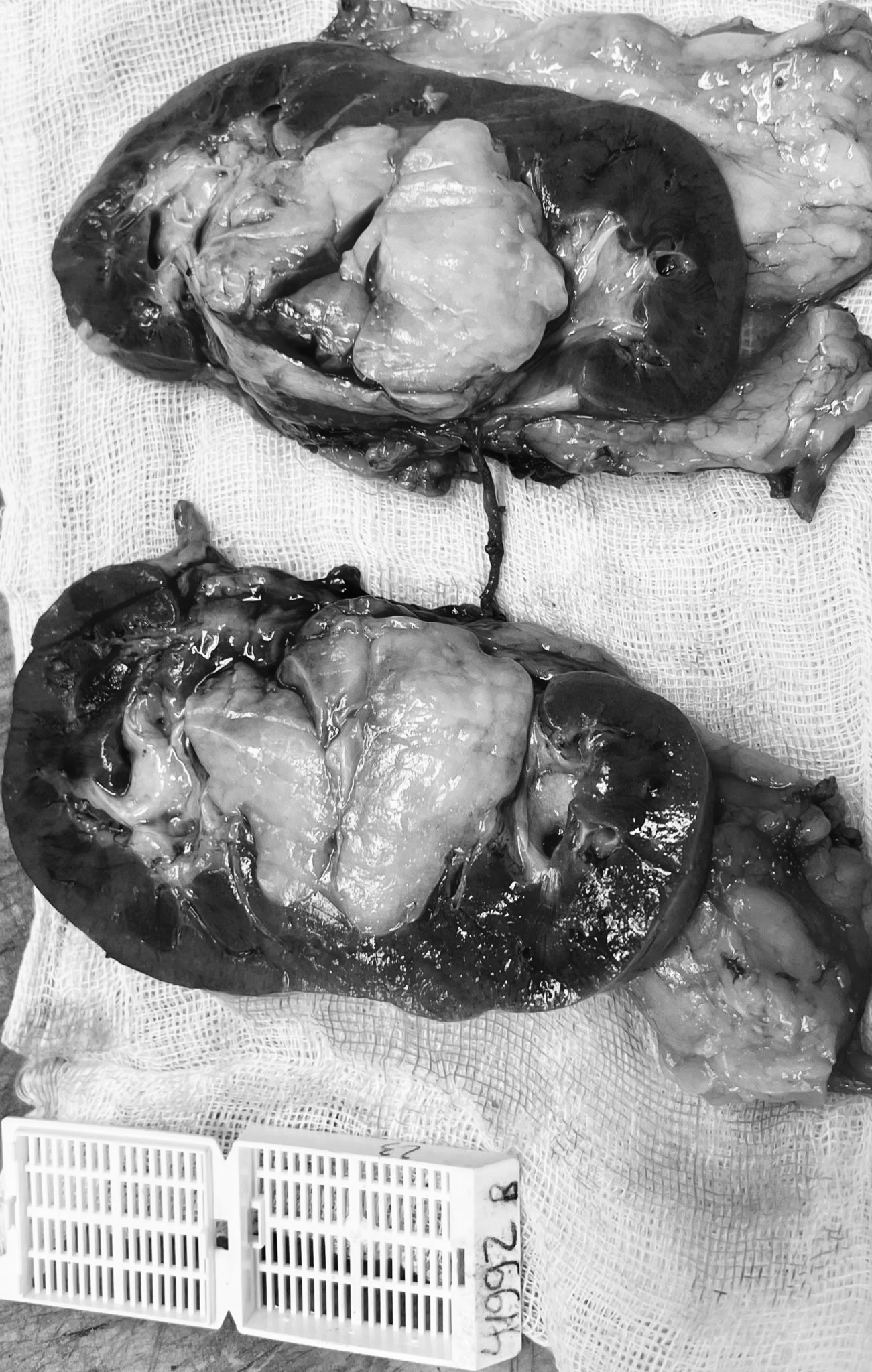 Lần đầu tiên tại Việt Nam phẫu thuật u cơ mỡ mạch thận lan lên đến tim   - Ảnh 3.