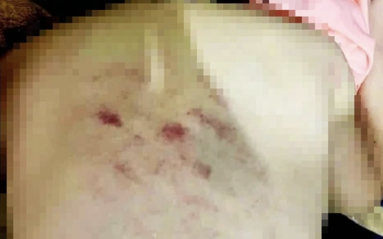 Vụ c&ocirc; gi&aacute;o đ&aacute;nh học sinh lớp 1 bầm t&iacute;m: Chuyển hồ sơ sang c&ocirc;ng an xử l&yacute;