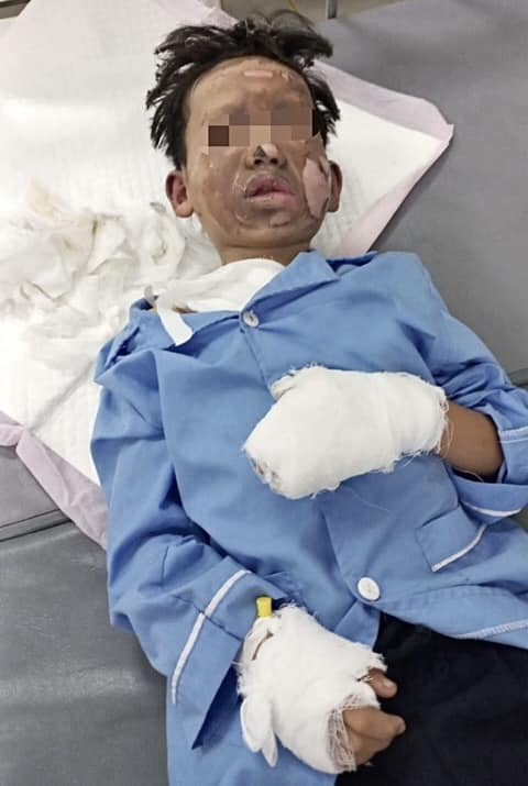 Thêm một bé trai bị bỏng nặng vì laptop phát nổ khi đang sử dụng- Ảnh 1.