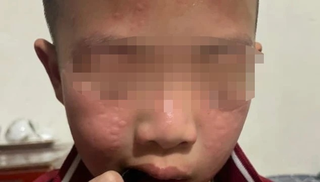 Hà Nội: Nhiều học sinh mẩn ngứa vùng mặt, sưng mắt sau khi trường phun thuốc diệt muỗi- Ảnh 2.