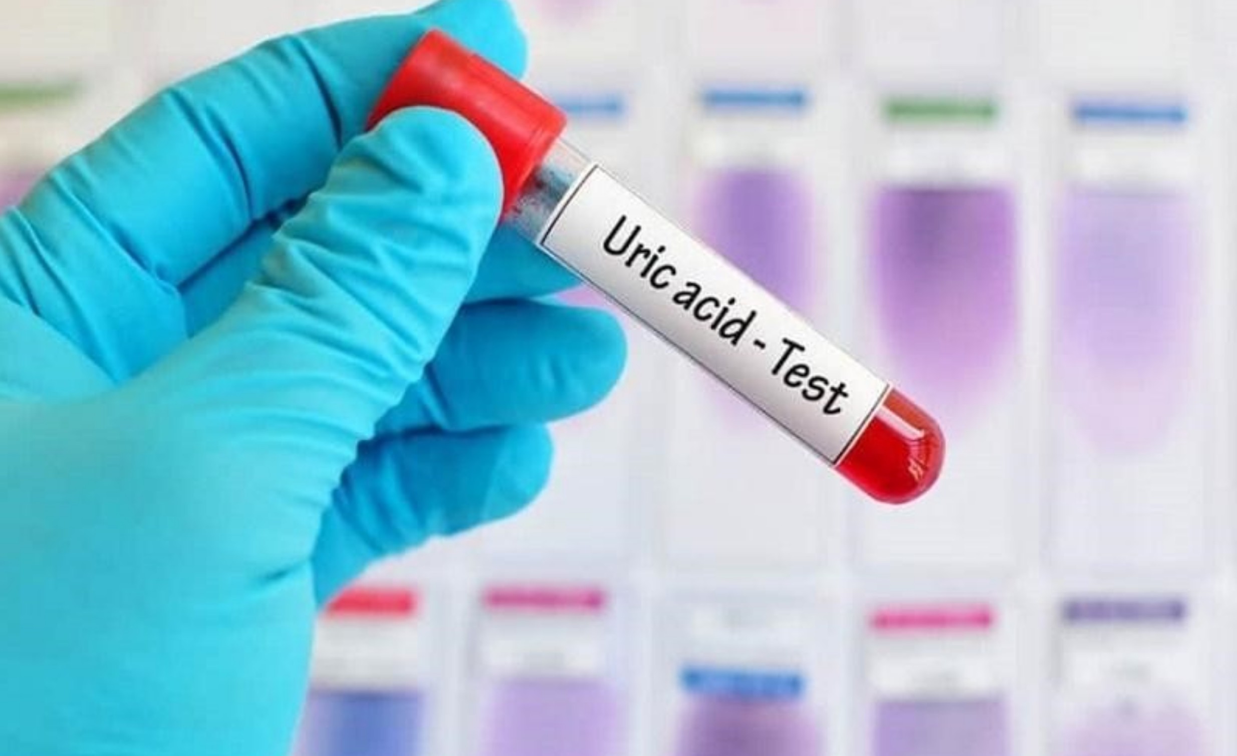 Liệu chỉ số acid uric máu cao là mắc bệnh gout?- Ảnh 1. Liệu chỉ số acid uric máu cao là mắc bệnh gout?- Ảnh 1.