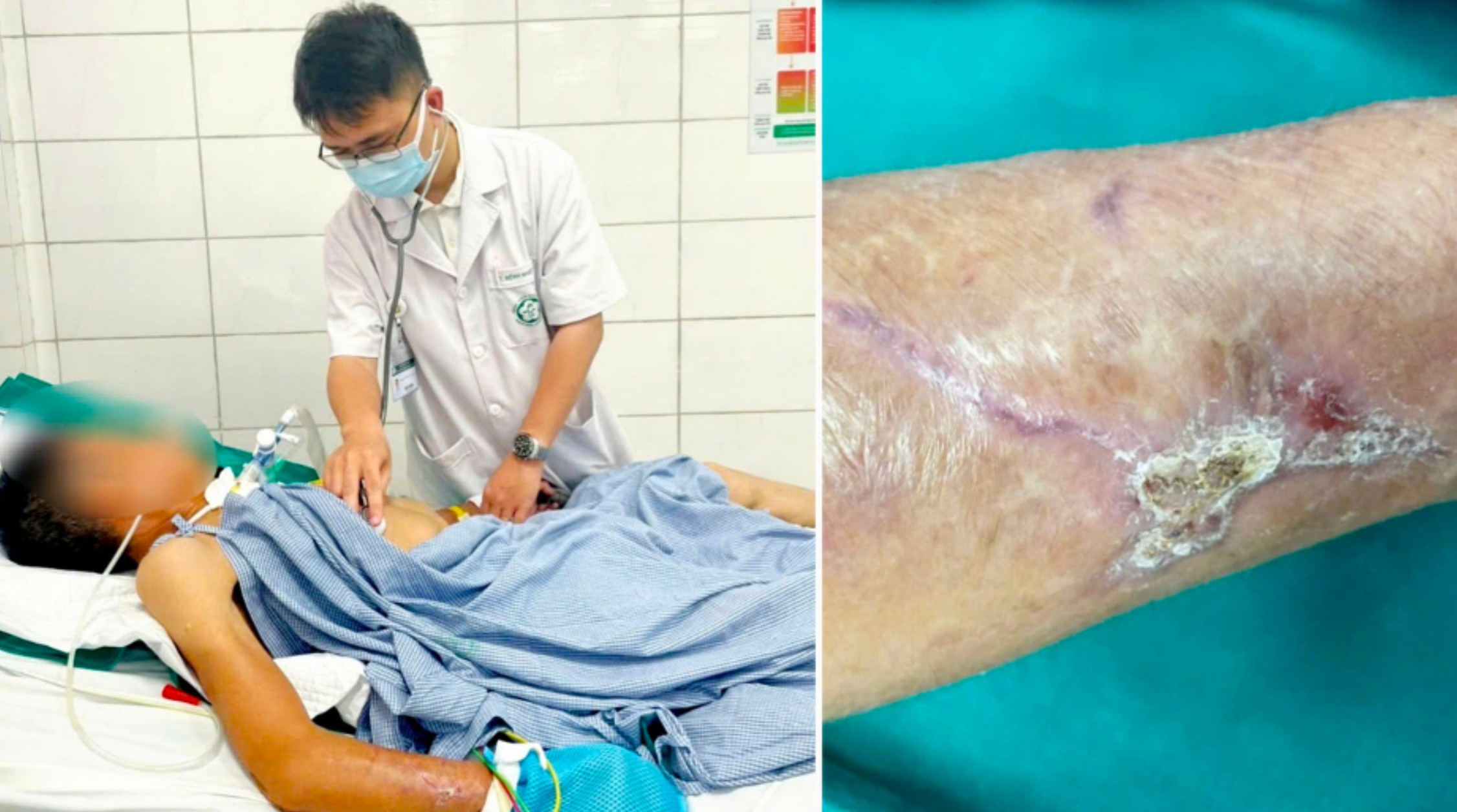 Cứng hàm, nói yếu vì uốn ván lại ngỡ đột quỵ não- Ảnh 1. Cứng hàm, nói yếu vì uốn ván lại ngỡ đột quỵ não- Ảnh 1.