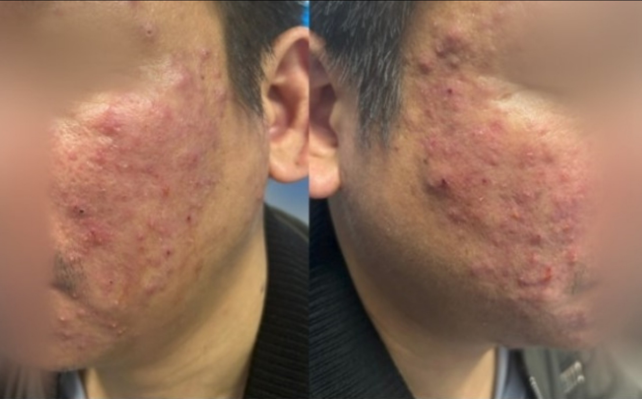 Tưởng mụn trứng cá, người đàn ông bất ngờ phát hiện viêm da do ký sinh trùng ít người biết- Ảnh 1.