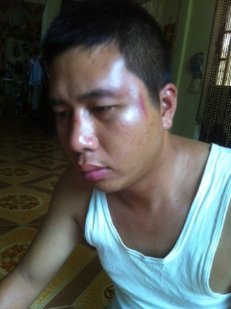 Tài xế Nguyễn Hữu Phi bị thương, sây sát ở mặt và tay...