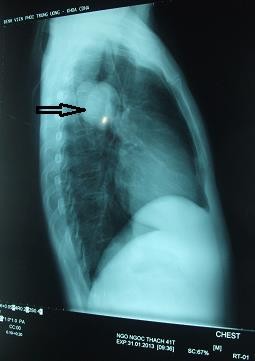 Chụp hình ảnh bệnh nhân ở Thanh Hóa bị sán chó làm tổ tạo u trong phổi (Ảnh: Zing news)