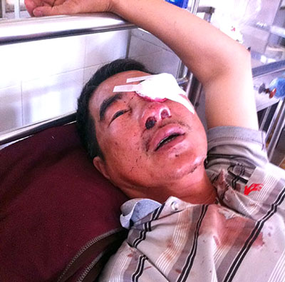 Ông Trương Triệu Lương bị ném đá gây hư mắt trái đang điều trị tại Bệnh viên Đa khoa tỉnh Đắk Lắk