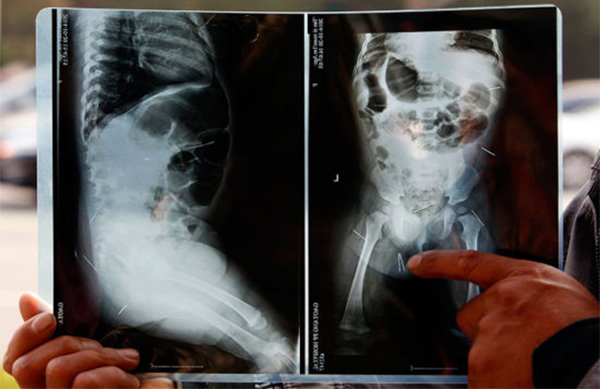 Ảnh chụp x-quang cho thấy rõ 12 chiếc kim khâu trong cơ thể bé Zixuan