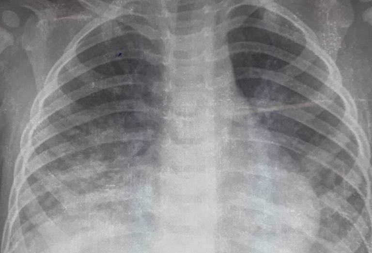 Hình ảnh tổn thương phổi của bệnh nhi D. trên phim