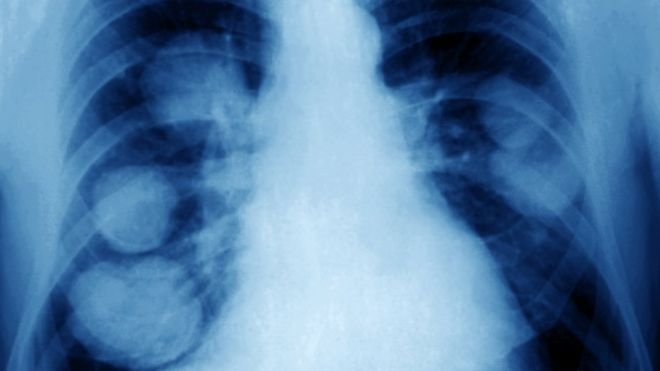 _93529193_m1340620-lung_cancer_x-ray-spl