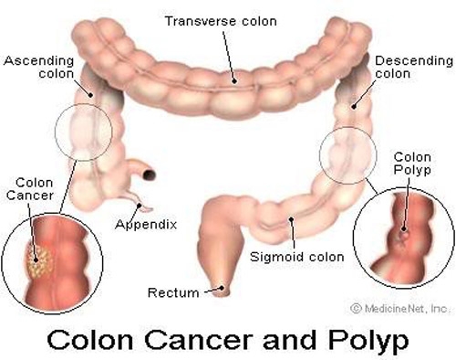 cat-bo-polyp-ngan-ngua-ung-thu-dai-truc-trang