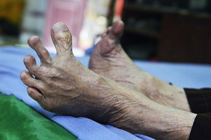 Các ngon chân trên bàn chân của cụ Phương là đặc t