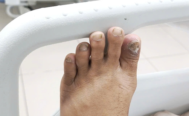 Liên tiếp bệnh nhân nguy kịch vì uốn ván- Ảnh 2. Liên tiếp bệnh nhân nguy kịch vì uốn ván- Ảnh 2.