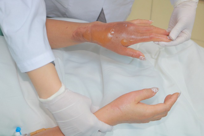 Một phụ nữ bỏng tay nặng do h&oacute;a chất th&ocirc;ng bồn cầu ph&aacute;t nổ- Ảnh 1.