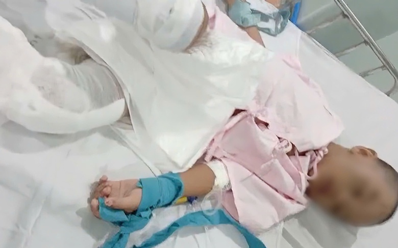 Bệnh viện th&ocirc;ng tin vụ b&eacute; trai bị bỏng nặng nghi cha ruột bạo h&agrave;nh