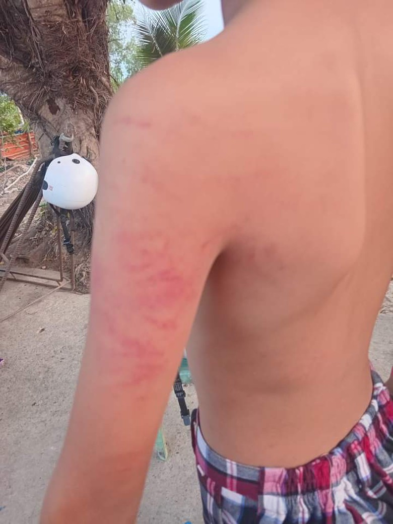 Con lớp 1 bị đ&aacute;nh bầm t&iacute;m cơ thể, mẹ đến trường t&aacute;t c&ocirc; chủ nhiệm- Ảnh 1.