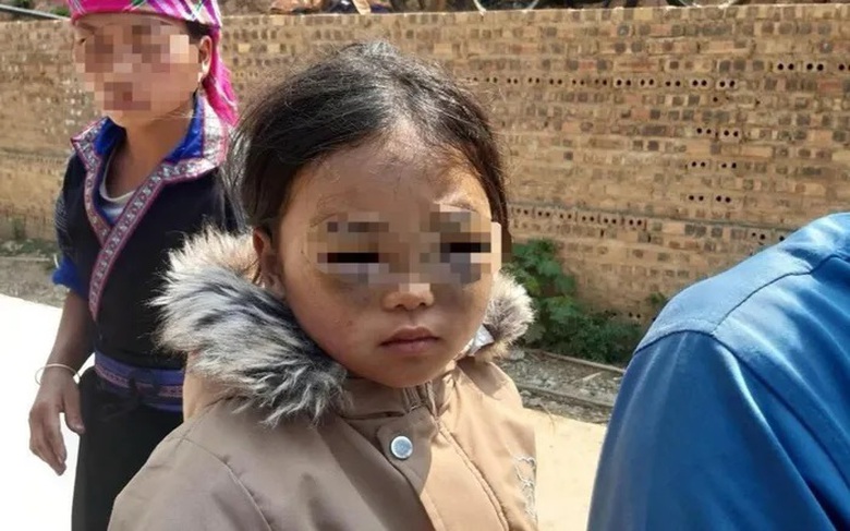 Công an Yên Bái vào cuộc điều tra vụ bé lớp 1 nghi bị cô giáo "tác động" tím mắt- Ảnh 1. Công an Yên Bái vào cuộc điều tra vụ bé lớp 1 nghi bị cô giáo "tác động" tím mắt- Ảnh 1.