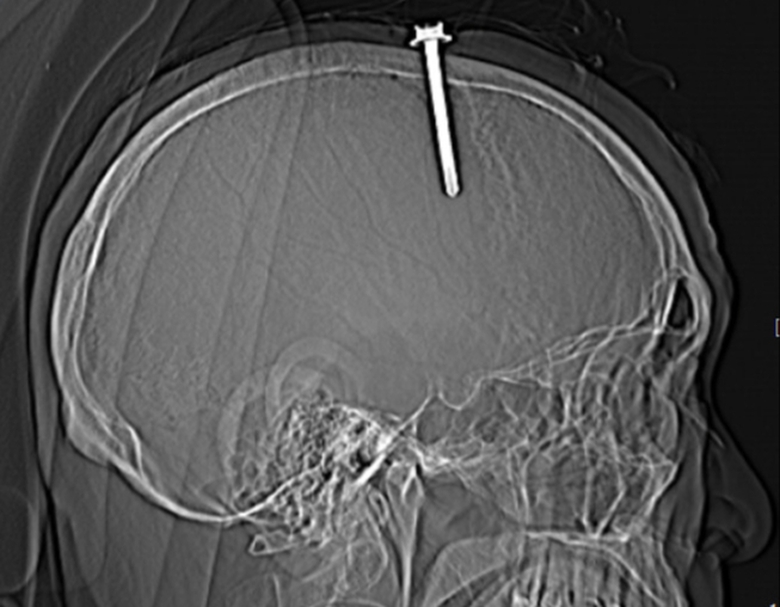 Người đ&agrave;n &ocirc;ng thường xuy&ecirc;n mất ngủ tự đ&oacute;ng c&acirc;y đinh d&agrave;i 5cm v&agrave;o đầu- Ảnh 1.