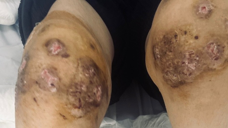 Để ong ch&acirc;m khớp gối chữa bệnh, một phụ nữ nguy kịch- Ảnh 2.