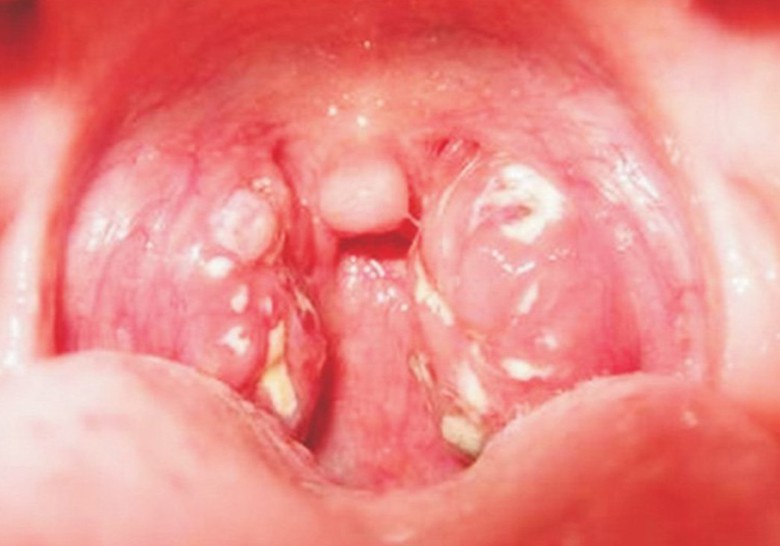 Vừa khiến một c&ocirc; g&aacute;i 18 tuổi tử vong, bệnh bạch hầu nguy hiểm như thế n&agrave;o?- Ảnh 1.