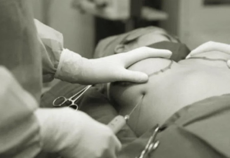 Nâng ngực bằng mỡ tự thân, một phụ nữ mưng mủ hai bên ngực, nhiễm trùng da- Ảnh 1. Nâng ngực bằng mỡ tự thân, một phụ nữ mưng mủ hai bên ngực, nhiễm trùng da- Ảnh 1.