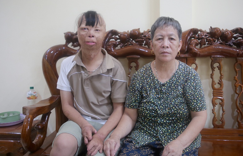 B&eacute; trai 3 tuổi bị bố ruột tẩm xăng đốt giờ ra sao?- Ảnh 1.