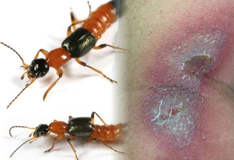 Nam thanh ni&ecirc;n chảy dịch to&agrave;n th&acirc;n v&igrave; đắp kiến ba khoang chữa ngứa- Ảnh 1.