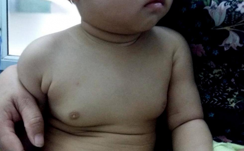 ph&igrave; đại tuyến v&uacute; ở trẻ nhỏ