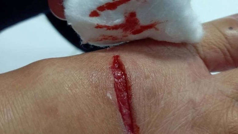 Người đ&agrave;n &ocirc;ng ở C&agrave; Mau tử vong sau 1 năm bị ch&oacute; dại cắn