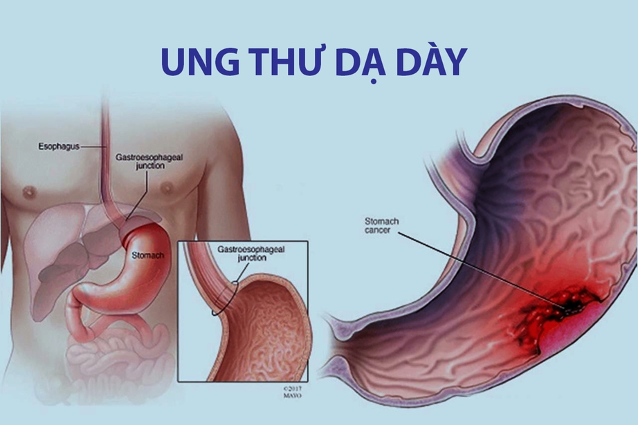 Dấu hiệu nào nhận biết ung thư dạ dày?- Ảnh 1. Dấu hiệu nào nhận biết ung thư dạ dày?- Ảnh 1.