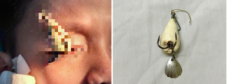 Xem c&acirc;u nh&aacute;i, nam sinh su&yacute;t m&ugrave; v&igrave; lưỡi c&acirc;u văng v&agrave;o mắt- Ảnh 1.