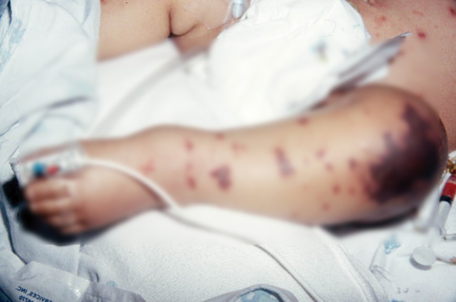 Cảnh gi&aacute;c với căn bệnh c&oacute; thể g&acirc;y tử vong trong 24 giờ- Ảnh 1.