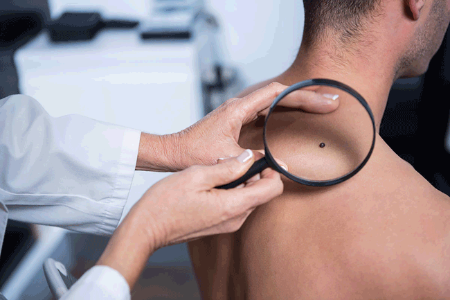 3. Da thay đổi: Theo Tổ chức Ung thư da Thế giới, đàn ông trên 50 tuổi có khả năng mắc và tử vong vì ung thư da cao gấp đôi. Tại sao? Một nghiên cứu cho thấy, đàn ông dành nhiều thời gian dưới ánh mặt trời trực tiếp hơn phụ nữ trong khi ít mặc áo chống nắng hơn; Đàn ông cũng có ít tóc che phủ da đầu và tai, hai khu vực họ có xu hướng phát triển ung thư da nhiều nhất. Ngoài ra, đàn ông thường ít quan tâm đến sức khỏe hơn, vì vậy khó để phát hiện sớm các bệnh ung thư hơn.