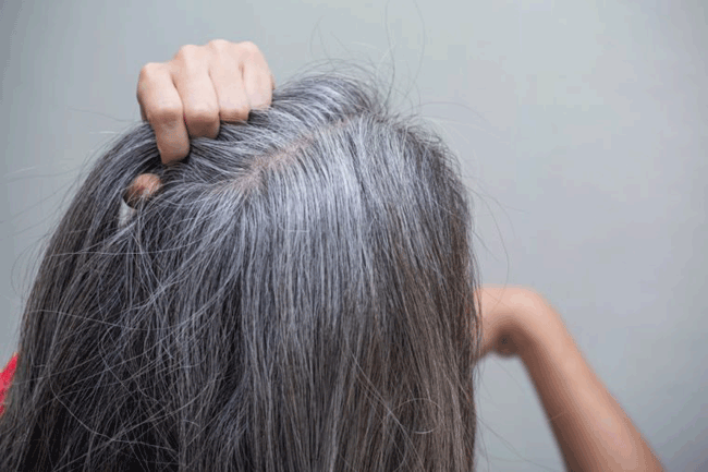 1. Căn bệnh khiến tóc bạc trắng xóa sau chỉ 1 đêm: Nếu tóc của bạn đột ngột chuyển sang màu trắng do căng thẳng hoặc gặp 1 tin dữ, bạn có thể bị mắc hội chứng Marie Antoinette. Một giả thuyết được đưa ra, bao gồm chứng rối loạn tự miễn nhắm vào melanin, ảnh hưởng đến sản xuất sắc tố.