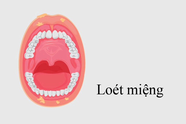 1. Loét miệng: Theo chuyên gia, nếu vết loét miệng kéo dài khoảng 2 tuần trở lên có thể là dấu hiệu của bệnh ung thư miệng. Dấu hiệu đau nhức cũng có thể tiết lộ bạn có khả năng bị ung thư hay không. Hầu hết vết loét lành tính đều khá mỏng và mềm, trong khi các khối u dày và cứng hơn. Thêm vào đó, vết loét lành tính hiếm khi chảy máu, trong khi khối u chảy máu thường xuyên.