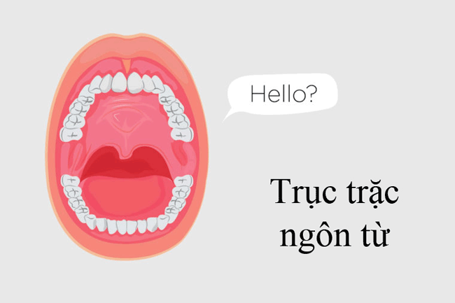 10. Trục trặc ngôn từ: Ung thư miệng ảnh hưởng đến lưỡi có thể làm cho việc nói chuyện trở nên đau đớn hoặc có thể khiến việc di chuyển lưỡi của bạn trở nên khó khăn hơn. Khi một trong những điều đó xảy ra, bạn có thể nhận thấy mình gặp khó khăn khi phát âm những từ mà bạn chưa bao giờ gặp rắc rối trước đó.