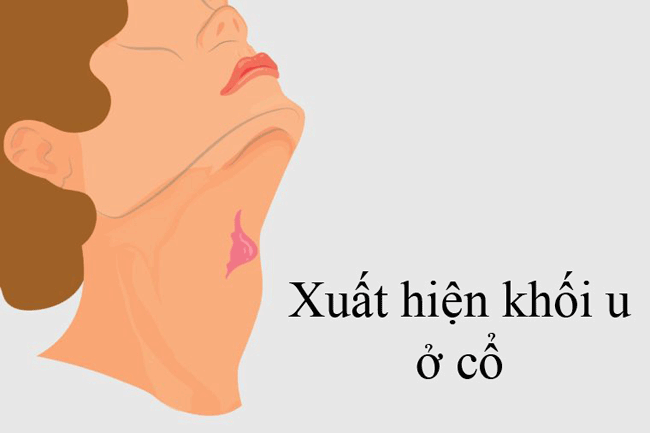 12. Xuất hiện khối u ở cổ: Khi ung thư miệng lây lan, các hạch bạch huyết thường là nơi tiếp theo bị ảnh hưởng, mặc dù bạn có thể sẽ nhận thấy các triệu chứng trong miệng trước khi thấy 1 khối u ở cổ.