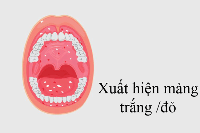 3. Xuất hiện các mảng màu đỏ hoặc trắng: Các mảng này mọc trên nướu, lưỡi hoặc các khu vực khác trong miệng có thể là tín hiệu cho thấy một khối u đang phát triển. Tốt nhất nên đến các cơ sở y tế để kiểm tra nếu nó kéo dài hơn 2 tuần, đặc biệt nếu bạn nhận thấy xuất hiện thêm các vết loét ở khu vực xung quanh.