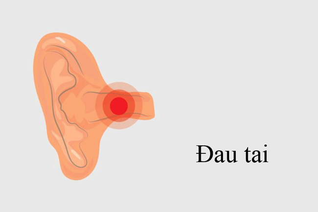 4. Đau tai chỉ ở 1 bên đầu có thể không liên quan gì đến tai. Các dây thần kinh tạo cảm giác cho lưỡi, phía sau miệng và hộp giọng nói cũng được liên kết với tai của bạn. Nếu bạn đang bị đau dai dẳng ở 1 bên tai và liên tục tái lại, hãy đến bệnh viện khám ngay lập tức. Trong trường hợp may mắn không bị ung thư miệng, cũng cần tìm ra nguyên nhân và điều trị dứt điểm.