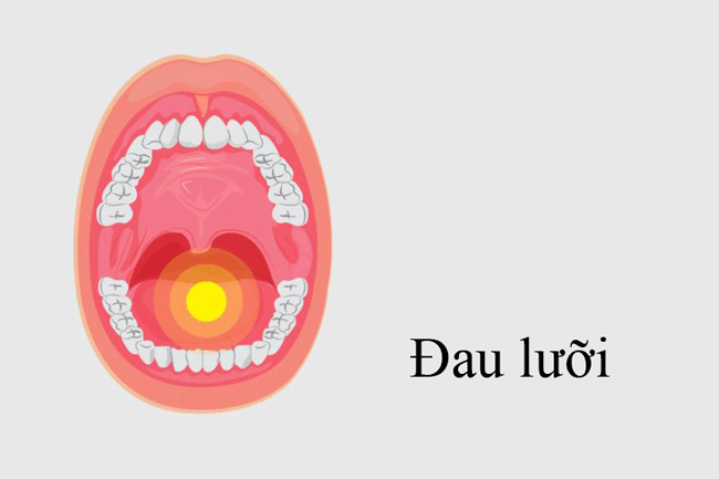 5. Đau lưỡi: Lưỡi là bộ phận rất nhạy cảm. Vì vậy, nếu nhận thấy bất cứ tổn thương nào gây đau ở lưỡi cần cẩn thận và sớm tìm ra nguyên nhân chính xác.