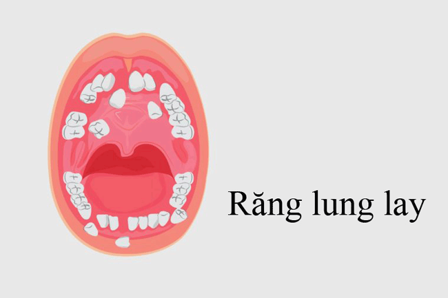8. Răng lung lay: Một khối u trên nướu có thể khiến 1 hoặc 2 cái răng gần đó bị lung lay. May mắn rằng, hầu hết các vấn đề về răng đều liên quan đến tình trạng răng của bạn chứ không phải ung thư.