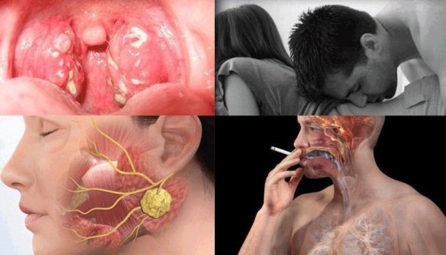 10. Bệnh trào ngược dạ dày thực quản: Khi axit từ dạ dày trào ngược lên thực quản, nó được gọi là bệnh trào ngược dạ dày thực quản (GERD). GERD có thể gây ợ nóng và tăng nguy cơ ung thư thực quản. Nhiều nghiên cứu khoa học được thực hiện đã tìm ra mối liên quan bệnh này cũng làm tăng nguy cơ mắc ung thư thanh quản và ung thư vòm họng.