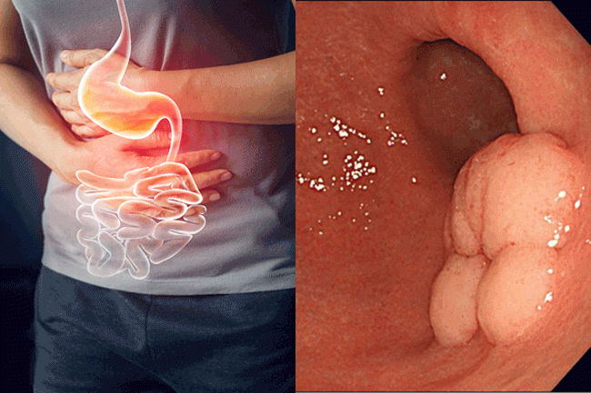 4. Mất cảm giác ngon miệng: Sẽ không có vấn đề gì nghiêm trọng nếu bạn bị mất cảm giác ngon miệng trong 1 hoặc 2 ngày, nhưng nếu tình trạng kéo dài hơn hãy đến gặp bác sĩ để được khám và chẩn đoán. Ung thư dạ dày là một trong nhiều tình trạng có thể gây mất cảm giác ngon miệng kéo dài.