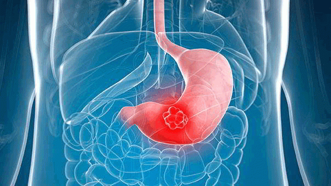 5. Bụng đầy hơi có thể là triệu chứng của ung thư dạ dày, đặc biệt là khi nó xảy ra sau bữa ăn. Nếu bạn thường xuyên cảm thấy chướng bụng và không có lời giải thích, hãy đến gặp bác sĩ để được xác định rõ nguyên nhân. Ngoài ung thư dạ dày, đầy hơi chướng bụng thường là triệu chứng đầu tiên của ung thư buồng trứng.