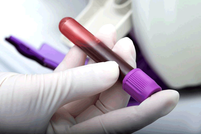 7. Bạn đã bị viêm gan C: Những người có tiền sử bị virus viêm gan C có thể bị ung thư gan sau khi chẩn đoán 10 năm. Đã có phương pháp điều trị có thể chữa khỏi bệnh viêm gan C và do đó ngăn ngừa ung thư gan, vì vậy mọi người nên kiểm tra sức khỏe để biết mình có nhiễm virus bệnh này hay không.