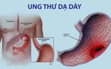 Dấu hiệu nào nhận biết ung thư dạ dày?