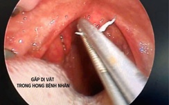 Cụ bà ho dai dẳng nhiều tuần, bất ngờ thủ phạm ẩn mình trong amidan