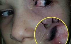 Bọ cánh cứng sống trong mắt bé gái 6 tuổi