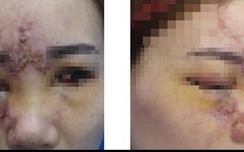 Nữ bệnh nhân mù mắt sau khi tiêm filler w88 link vao w88 moi nhat làm đẹp