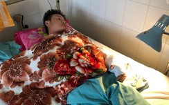 Ghép nối thành công bàn tay thw88 mobile niên bị chém đứt lìa sau cuộc nhậu