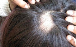 Rụng tóc sau khi w88, phải làm sao?